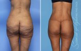 orange-county-lower-body-lift-patient-57-back.jpg