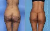 orange-county-lower-body-lift-patient-57-back.webp