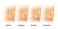 Breast_Lift_Procedure.jpg