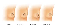 Breast_Lift_Procedure.webp