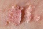 sintomas-de-hpv_26290.webp